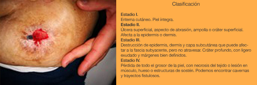 Herida por presión