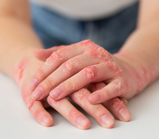 Persona que sufre psoriasis en la piel Persona que sufre psoriasis en la piel