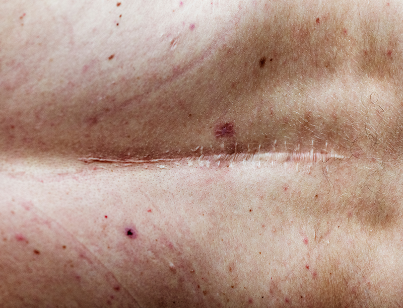 Anciano con cicatriz de cirugía en espalda. Anciano con cicatriz de cirugía en espalda.